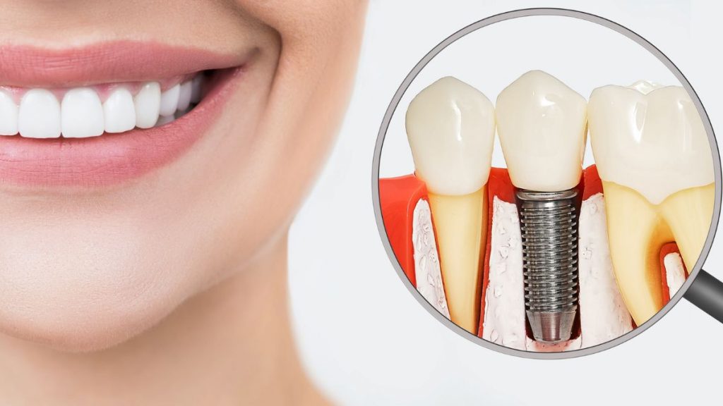 implante dentario pelo sus